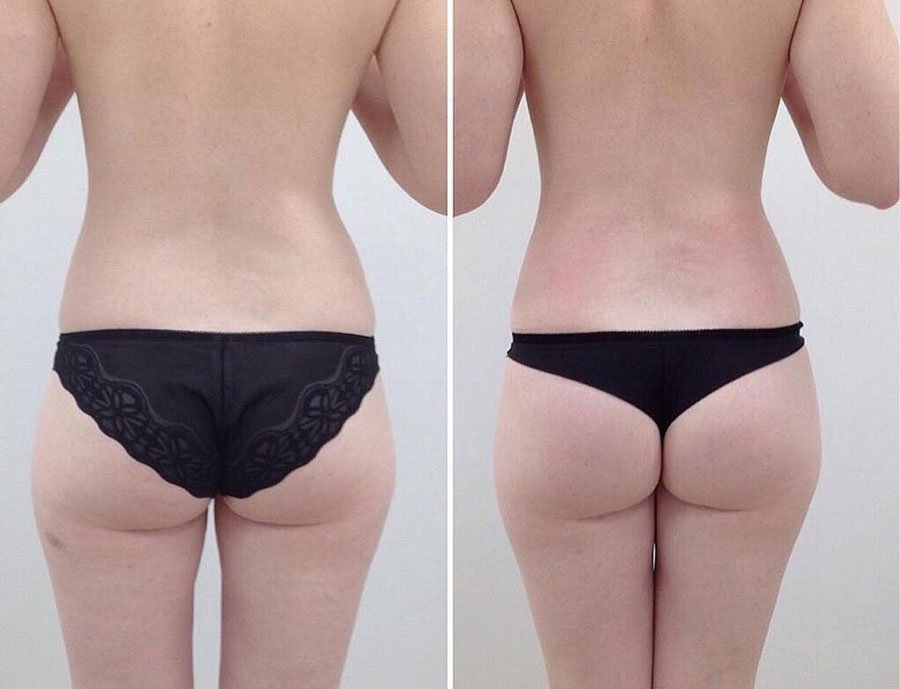 Эффект от LPG | до и после