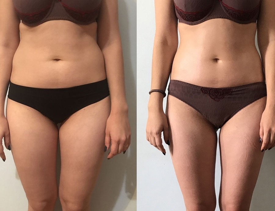 Эффект от LPG | до и после