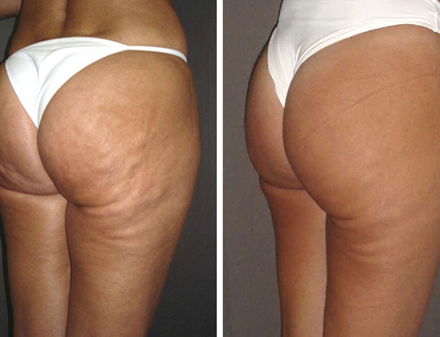 Эффект от LPG | до и после